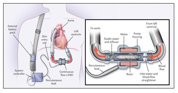 Representación de cómo se vería el Impulsor para bombas de sangre en el cuerpo. (Foto:http://www.nejm.org/doi/full/10.1056/NEJMoa067758)