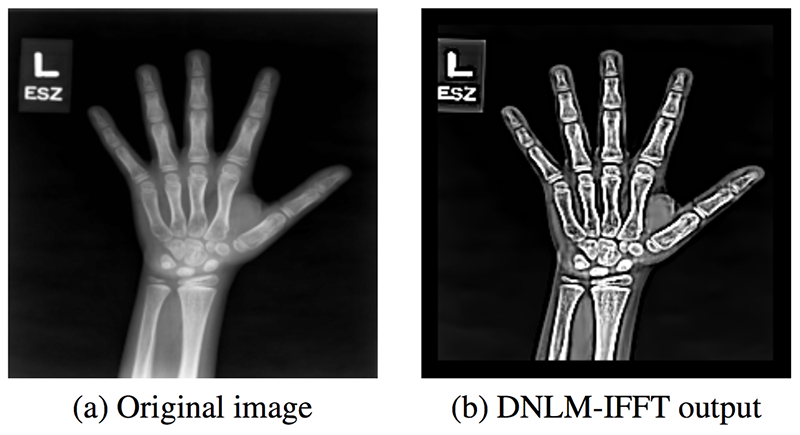 Radiografía antes y después del tratamiento con filtros.