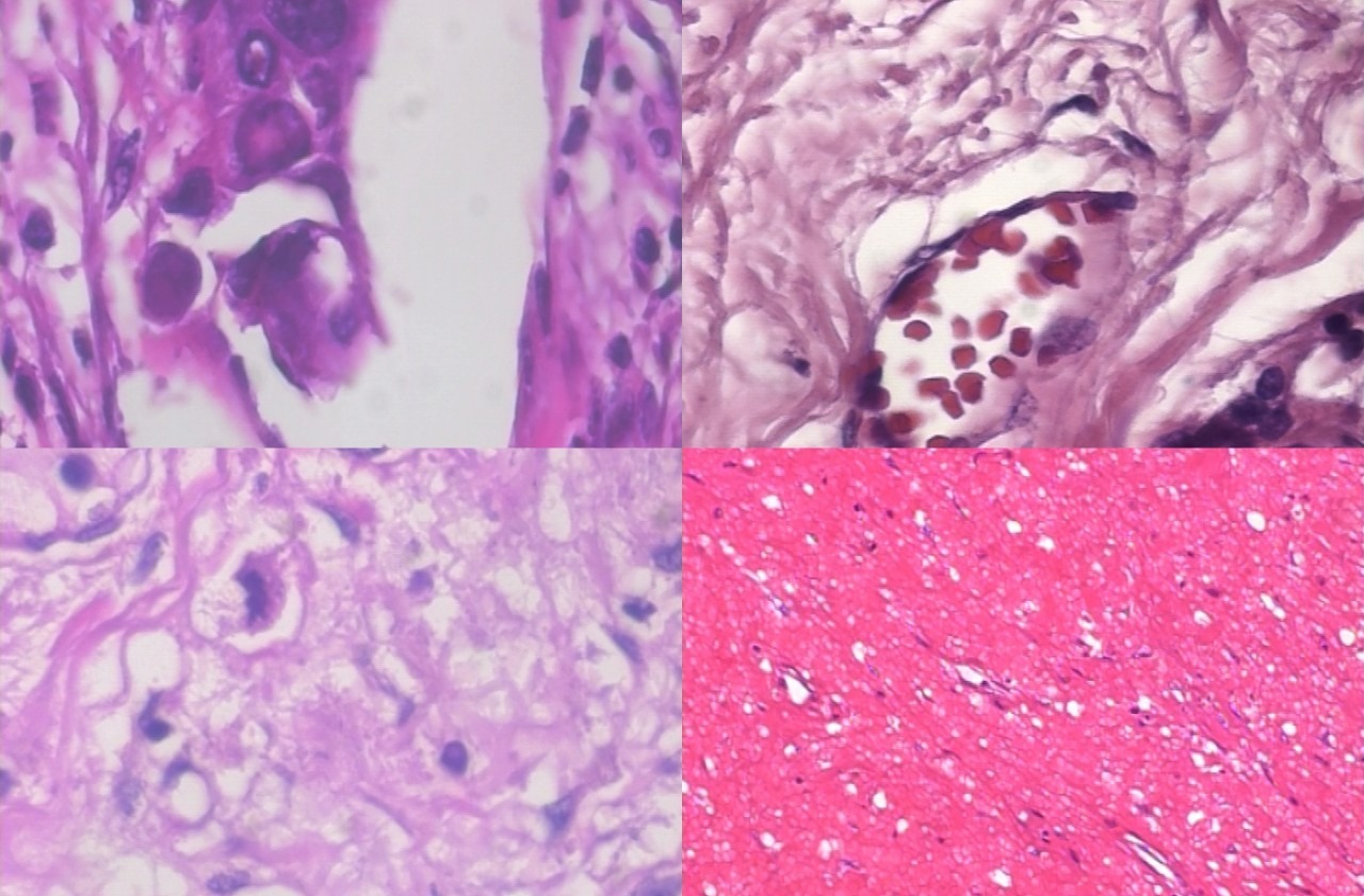 Cancer De Mama Inteligencia Artificial Agilizara El Diagnostico Hoy En El Tec