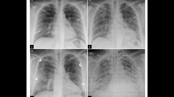 Imagen de radiografías de pecho.