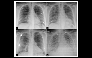 Imagen de radiografías de pecho.