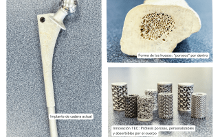 La imagen muestra una prótesis de cadera actual. Un hueso, con su forma porosa y los nuevos implantes porosos del TEC