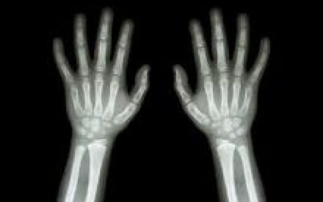radiografía de dos manos 